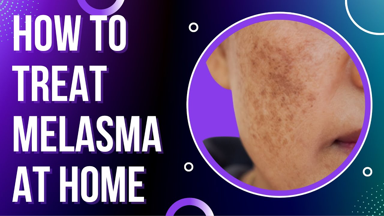 How to treat  MELASMA at Home –  Treat DARK SPOTS & PATCHES on the skin